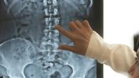doctor analyzes the x-rays of a radiograph and points with her index finger to the point where the patient's congenital scoliosis is present.