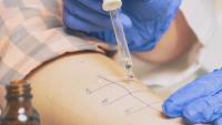 doctor doing skin prick allergy test on a woman’s arm