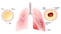 Bronchiectasis. Normal bronchus and bronchiectasis. enlarged small airways that collect mucus and cause recurrent lung infections. obstructive lung disease.