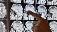 Critical care neurologists examione a brain scan.