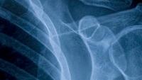 xray of shoulder and ribs.
