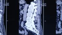 CT image of the spine of a patient with scoliosis and protrusion of the intervertebral disc.