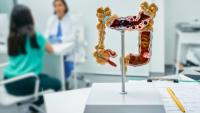 model of a colon in the foreground with patient and doctor behind