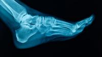 X-ray of adult foot.