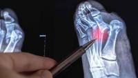X-ray image of the foot with a pen pointing to the midfoot bones to highlight an area of concern.