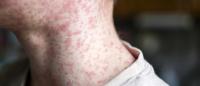 A close-up of a person's neck and upper neck area. The person appears to be in his late 40s or early 50s, with short, dark hair. The skin around the neck is covered in red, inflamed bumps and bumps, which are typical of acne or psoriasis.
